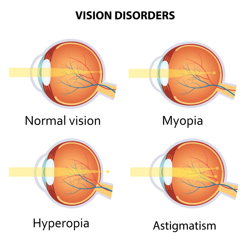 refractive error (myopia hyperopia astigmatism))