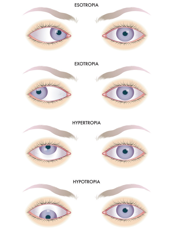 https://www.stereooptical.com/wp-content/uploads/2017/12/Strabismus-canstockphoto18868735.jpg